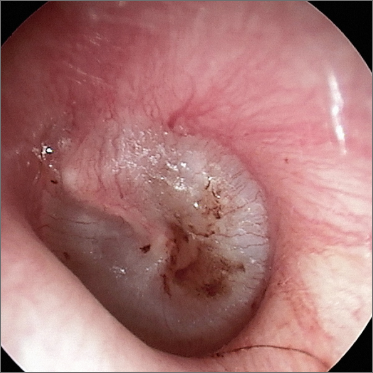 picture of an infected eardrum