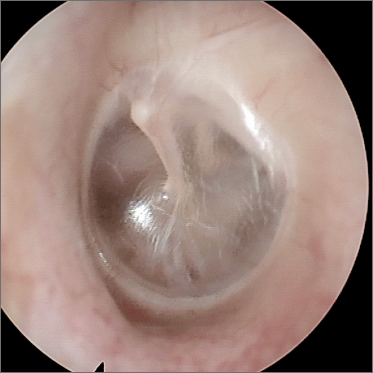 picture of a normal eardrum